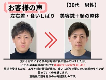 サロンスマイル/30代美容鍼ビフォーアフター