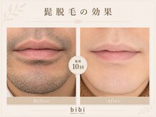 ビビ(bibi)/メンズヒゲ脱毛施術10回