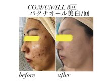 マーレン(Malen)の雰囲気（ニキビ集中ケアで肌質改善）