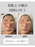 メイクでも隠せないたるみに!たるみ集中トリートメント