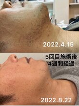 デジール/【メンズ脱毛/ニキビケア脱毛】