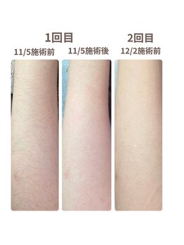 カラ(CARA)/1回目から結果が出る脱毛！