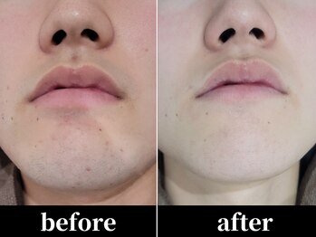 ユアースタイル 四日市店(YOUR Style)/【メンズ脱毛】ヒゲ脱毛 #脱毛