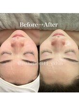 エステティックス ナインワンワン 横浜(Esthetics911) /ニキビケア跡に水素+高周波ケア!