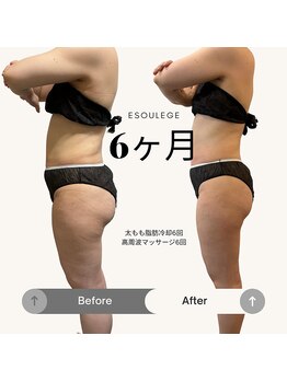 エスラージュ(esoulage)/脂肪冷却　太もも