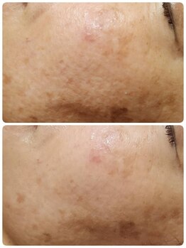 イル 名取店(iru)/剥離なし！国産ハーブピーリング