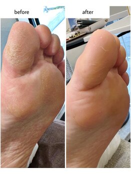 ケアプラス(care plus)/足裏角質ケア