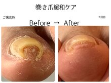 巻き 爪緩和施術!※お爪の状態により緩和のスピードは異なります