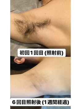 ビダンドウ(BIDANDO)/男性も◎【海にプールに】脇脱毛