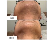 濃い毛・薄い毛どちらにもアプローチできる結果重視の脱毛！