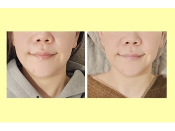 アン 銀座(ann)/レモンボトル【あご】初回