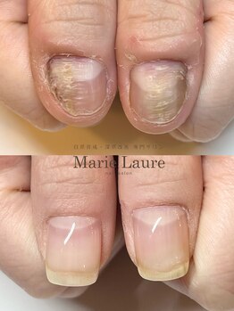 マリーロール 梅田店(Marie Laure)/自爪育成/深爪矯正/ネイルケア