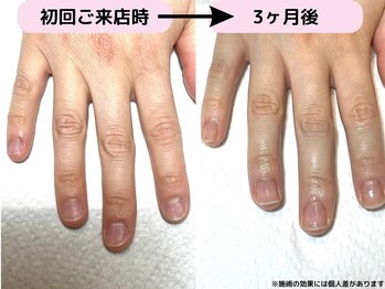 カピリナ(Ka Pilina)/自爪育成・川崎