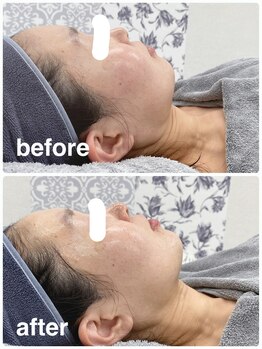 ハロ 南青山(HALO)/小顔3層打ちフェイシャル