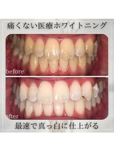 ホワイトニングビューティー つくば店/ホワイトニング