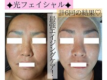 アースコアフュールボーテ ひたち野うしく店(EARTH coiffure beaute)/光フェイシャル