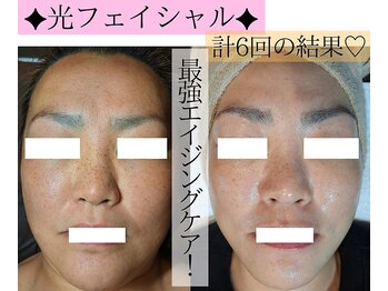 アースコアフュールボーテ ひたち野うしく店(EARTH coiffure beaute)/光フェイシャル