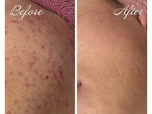 パルス/ニキビケア/肌荒れにも効果的★