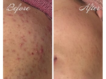 パルス/ニキビケア/肌荒れにも効果的★