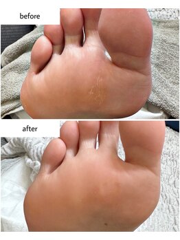 ケアプラス(care plus)/足裏角質ケア