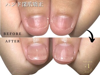 プラスワン(+1)の写真/【見た目改善】手爪のお悩み解決かかりつけサロン!深爪矯正・むしり爪・縦割れ・丸爪…爪を傷つけない施術!