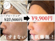 ハーブピーリング（はくりあり/なし）で透明感ある輝く素肌へ