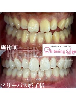 ホワイトニングサロン 福岡博多店/ホワイトニング