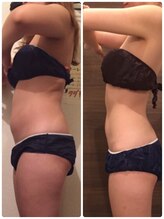 エステサロン 美飾り イオンモール木更津店/before⇒afteｒ/脂肪分解注入