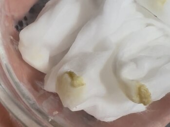 サラグランデ(Sara Grande)/大量のドロドロ角栓が!