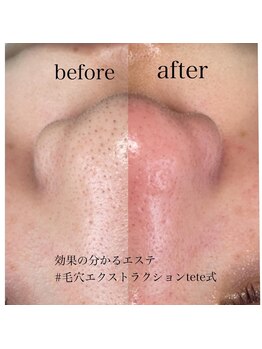 アイシェリー(eyecherie)/毛穴エクストラクション