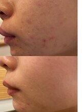 長寿鍼灸院 長寿整骨院/美容鍼25本の効果★肌質改善