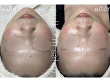 プル スキンサロン(pull skin salon)の雰囲気（赤み、敏感肌、アクネ、肌トラブルでお悩みの方もお任せください）