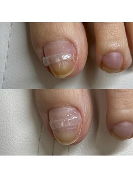 巻き爪矯正4回目(左親指)