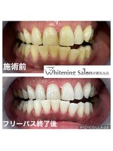 ホワイトニングサロン 京都烏丸店/ホワイトニング施術例
