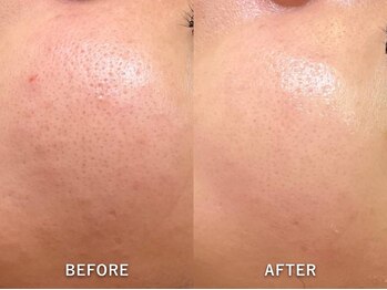 エリンダ(E LINDA)/毛穴洗浄