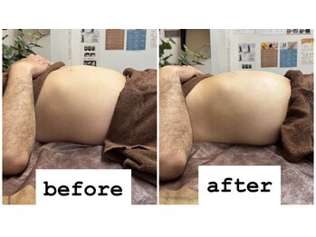 リベル(Liber)/痛みの少ない★痩身エクシリス