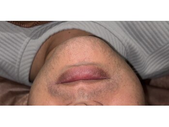 ベルフィオーレ(bel fiore)/30代男性 初回Before