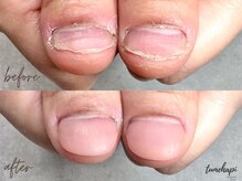 ツメハピ(tumehapi)/深爪ケア ビフォーアフター♪