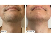 トパーズ 藤枝店(Topaz)/メンズ脱毛　ひげ脱毛