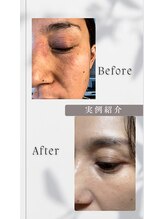 アイヲン(Aiwon)/【花粉】【皮膚過敏】