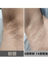 キムラケ 和光別邸(木村家 KIMURAKE)/メンズ脱毛ヒゲビフォーアフター