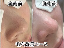 スナグル(Snuggle)/毛穴改善コース