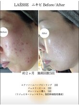イロドリ(irodori)/LAESSEニキビbefore/after☆