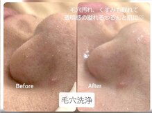 毛穴洗浄で肌に透明感を♪素肌で勝負　エステ/痩身/脱毛　