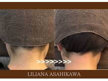 リリアーナ アサヒカワ(LILIANA ASAHIKAWA)/美肌光脱毛（うなじ後ろ）