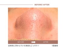 イエス マイサロン(yes My Salon)/毛穴洗浄症例