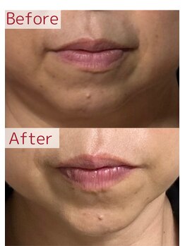 プレイス 太融寺店(PLACE)/プラズマの力で肌の奥まで