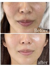 ワイグレイス(Y.GRACE)/マーメイドセルフェイシャル