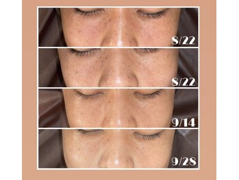 ルアンビューティー メディカルプラス(Luan beauty MEDICAL+)/シミ/美白ケア