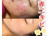 【最強毛穴ニキビケア】国産ハーブピーリング×ハーブ炭酸ガスパック￥8800